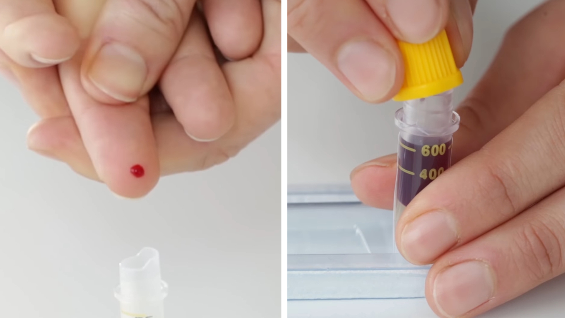 allergy-test-taking-blood-sample